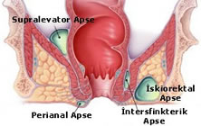 Perianal Apse