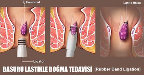 Hemoroid Lastikle Boğma